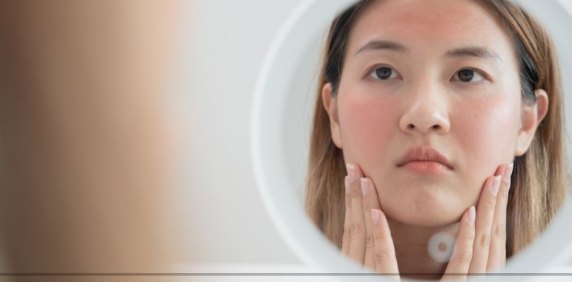 A woman looking at her reflection in a mirror. She has a rash on her face.