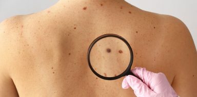 A gloved hand holding a magnifying glass over a woman's back to inspect a mole.